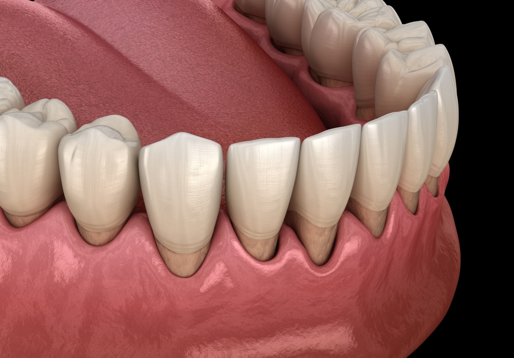 Gum,Recession,Process.,Medically,Accurate,3d,Illustration