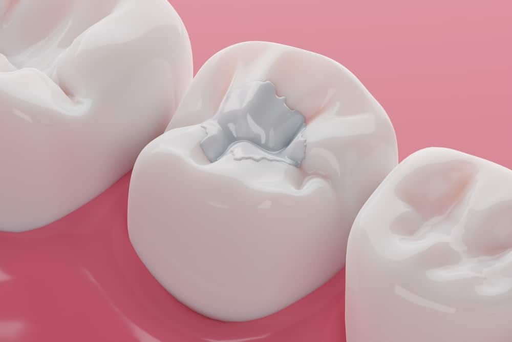 3D image of a molar tooth with a tooth-colored filling in the center