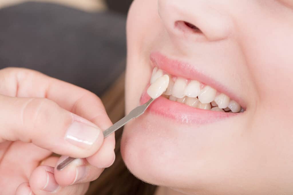 A dentist matching porcelain veneers to a patient's teeth