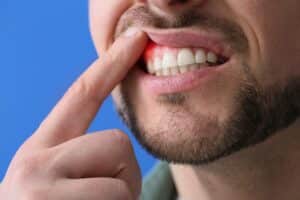 A man with gum disease lifting his lip to show his gums and teeth