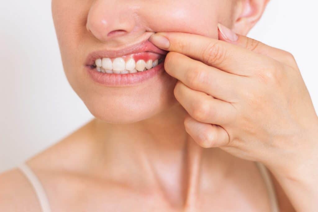 A close-up shot of a gum surgery patient’s mouth before LANAP
